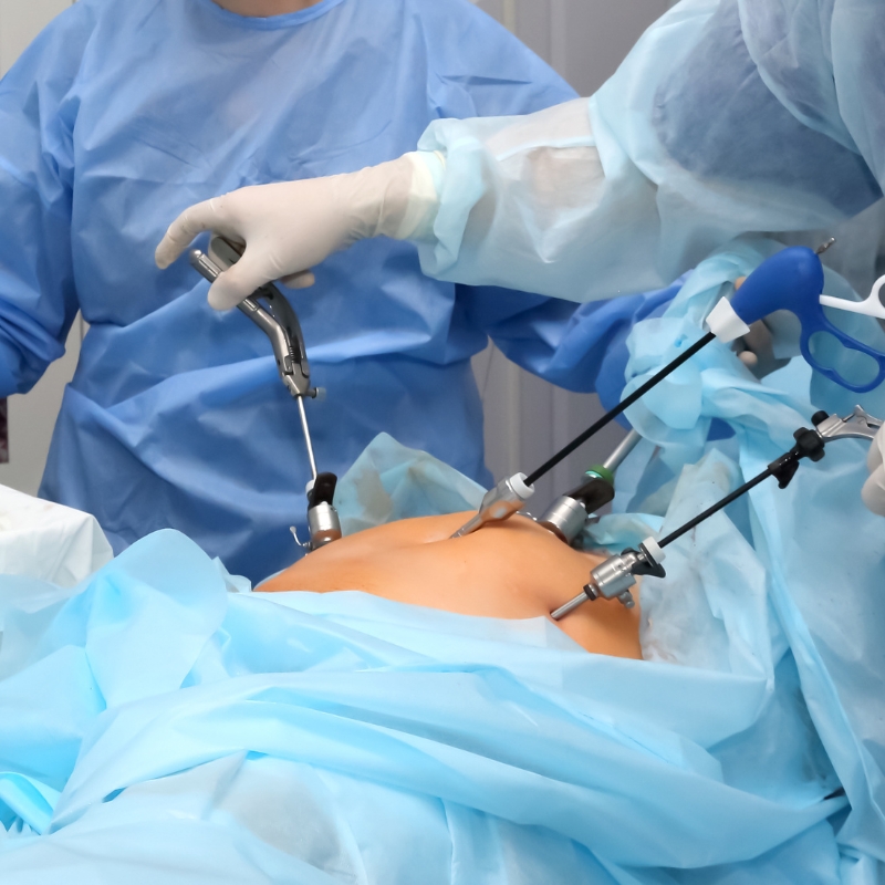 Laparoscopy
